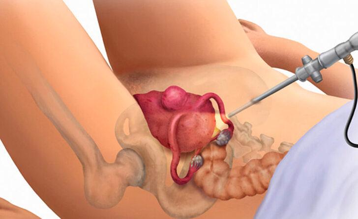 Лечение эндометриоза: методы и подходы