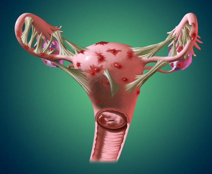 Борьба с эндометриозом: как вернуть здоровье и фертильность