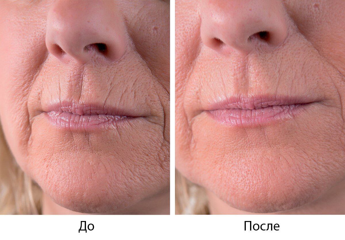 Как проходит процедура биоревитализации с Вискодермом