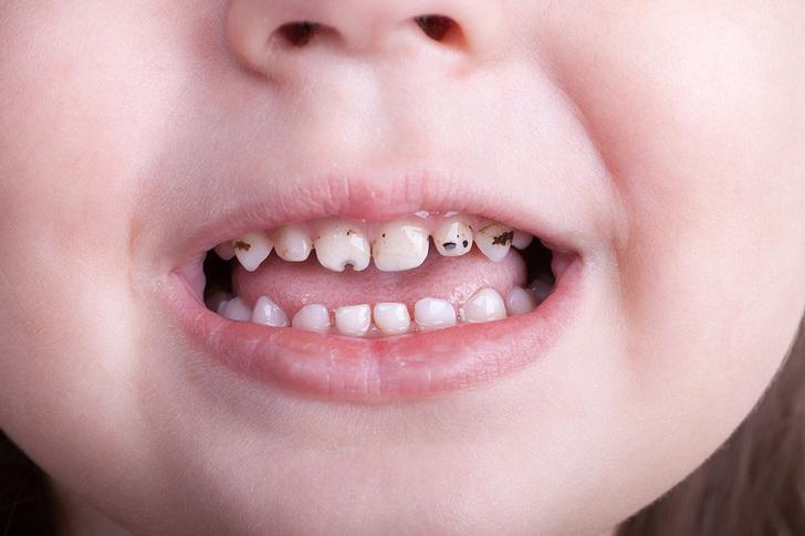 Вредны ли детские зубные пасты с фтором?