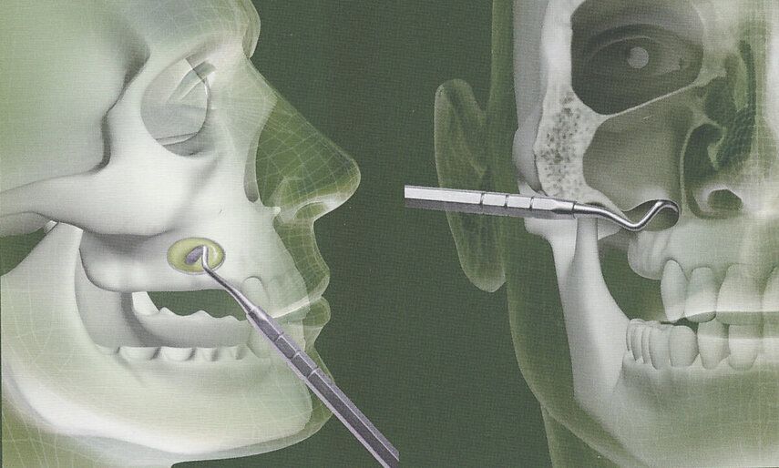 Гайморотомия