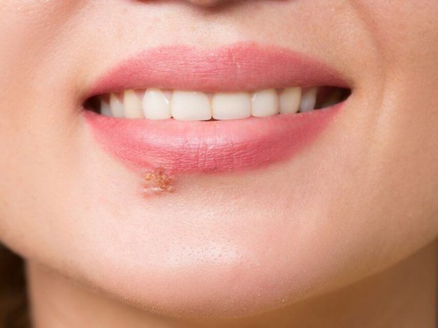 Как снизить частоту рецидивов герпеса