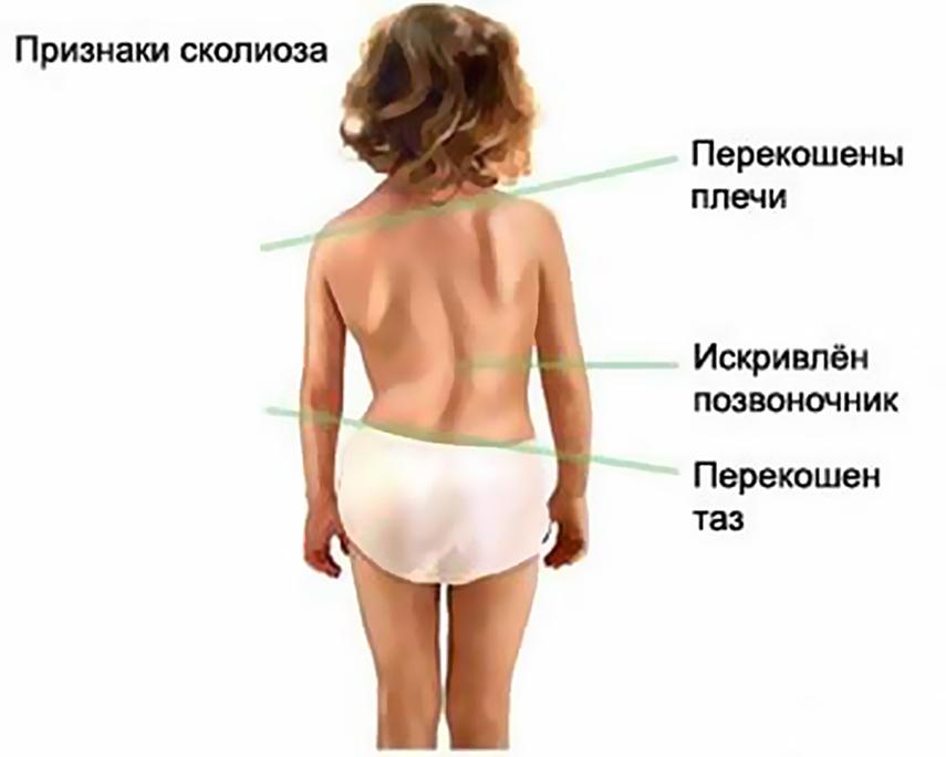 Признаки нарушения осанки