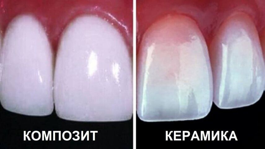 Композитные виниры: быстрая трансформация улыбки за один визит?