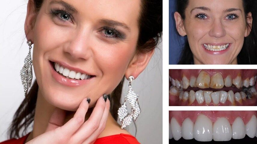 Вы — идеальный кандидат для...? Определяем ваш тип виниров