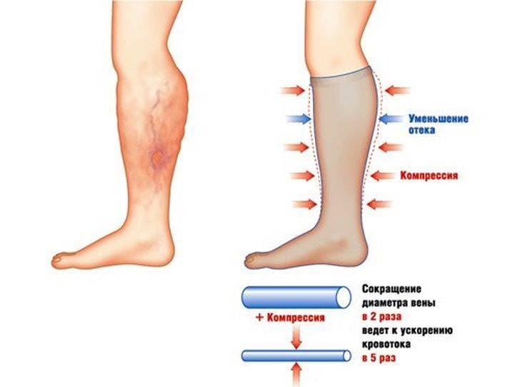 Как компрессионный бандаж может помочь улучшить кровообращение и уменьшить отеки?