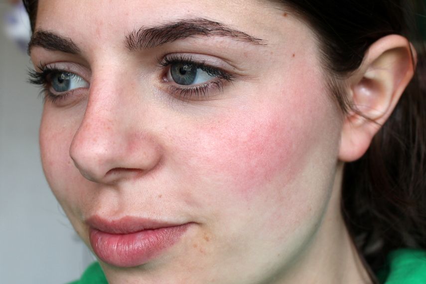 Кожа не в кадре? Почему даже правильное питание не спасает от пятен и блеска