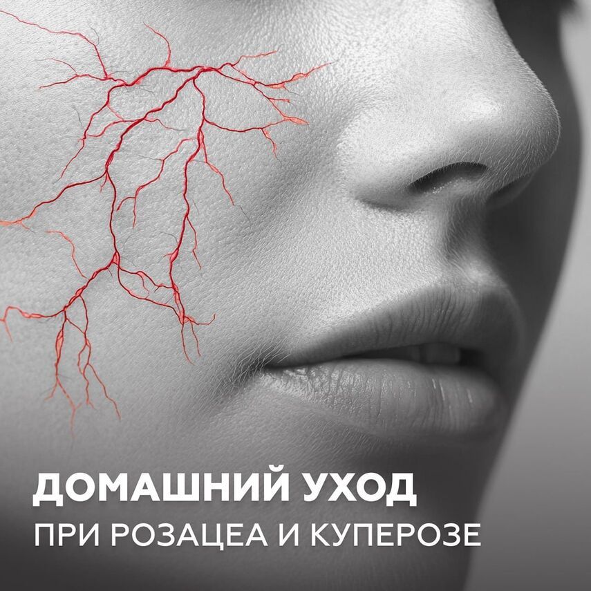 Как лечить купероз: тяжелая артиллерия (Аппаратные методы)