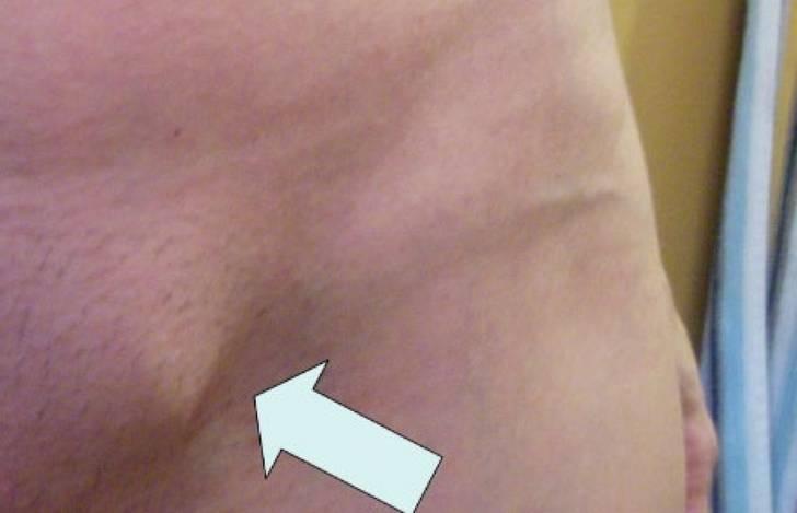 Вид паховой грыжи