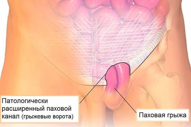 Вид паховой грыжи