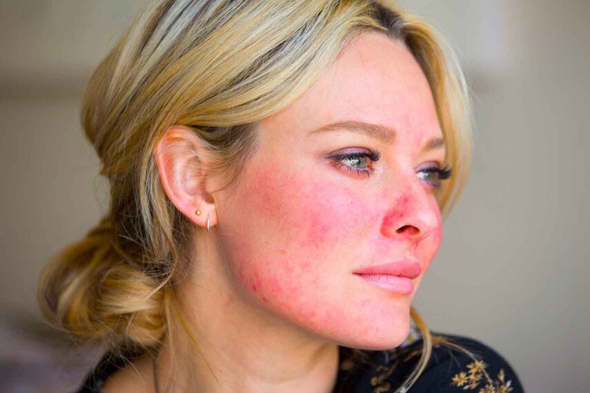 Лечение розацеа: новейшие подходы