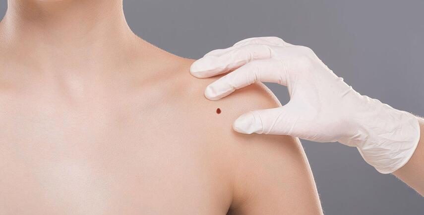 Ангиомы и гемангиомы: современные методы лечения