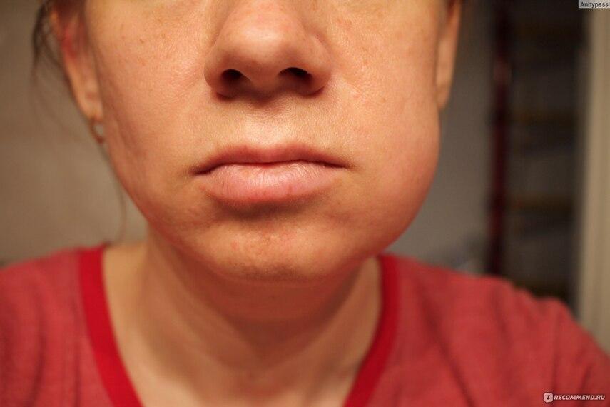 Осложнения при зубном флюсе