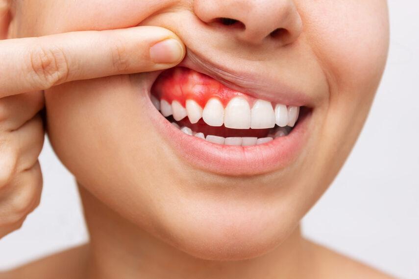 Домашние методы лечения флюса: как победить без стоматолога?