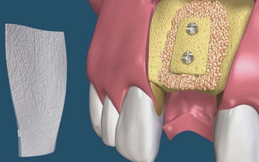 Костная пластика: что это за «стройка» у вас во рту?