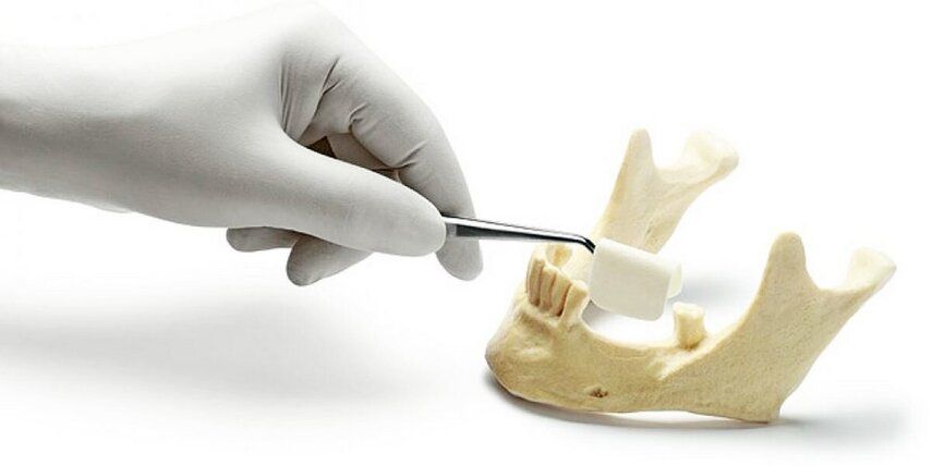 Один диагноз — разные решения. Виды наращивания кости