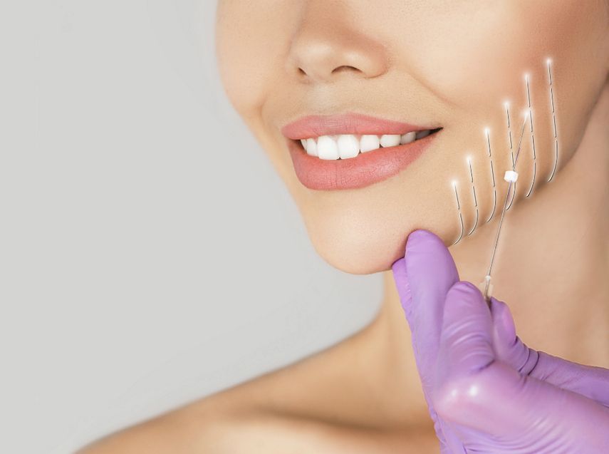 Нитевой лифтинг