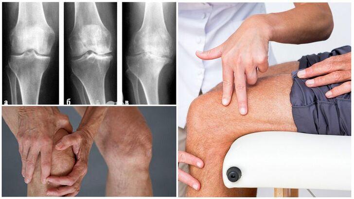 Клиническая картина остеоартроза коленного сустава