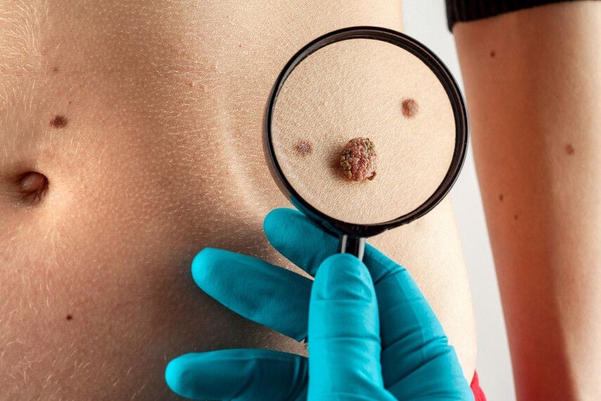 Профилактика папилом