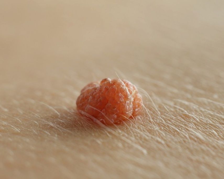 Папилломы: Полное руководство по симптомам, лечению и профилактике