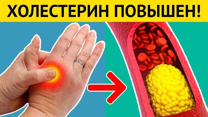 Симптомы повышенного холестерина