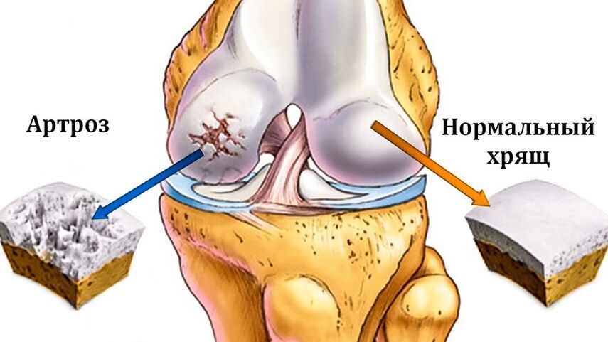 Плазмолифтинг при артрозе коленных суставов