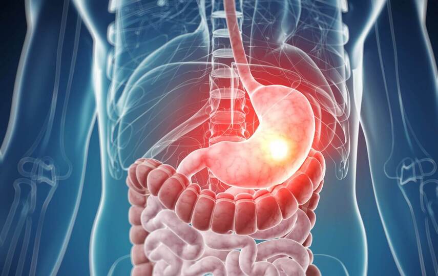 Что такое язва желудка?