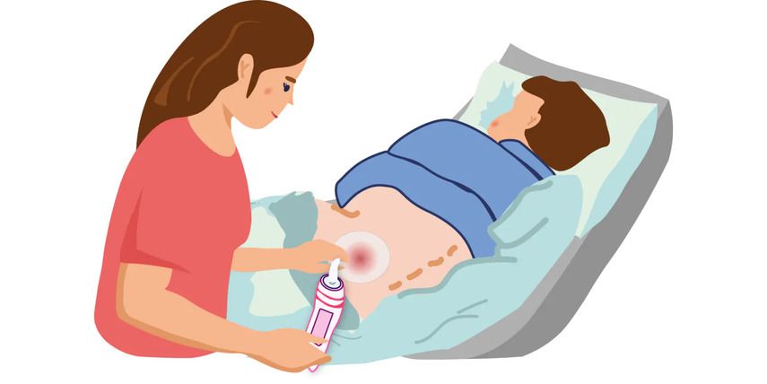 Алгоритм лечения пролежней в домашних условиях: от мази до повязки