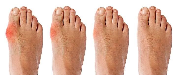 Лечение ревматоидного артрита