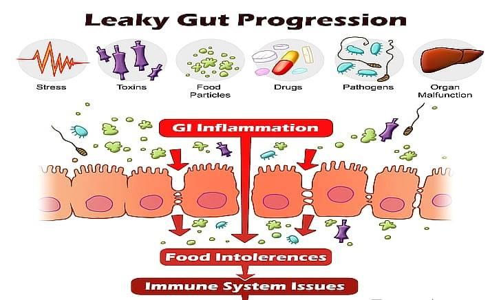 синдром дырявого кишечника
