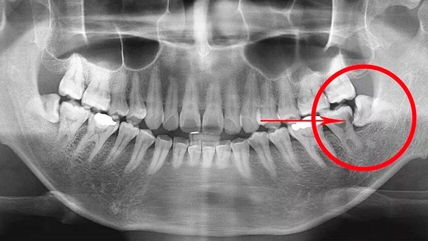 Особенности удаления корней зубов мудрости