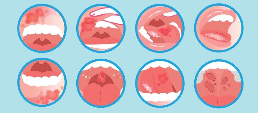 Виды стоматита