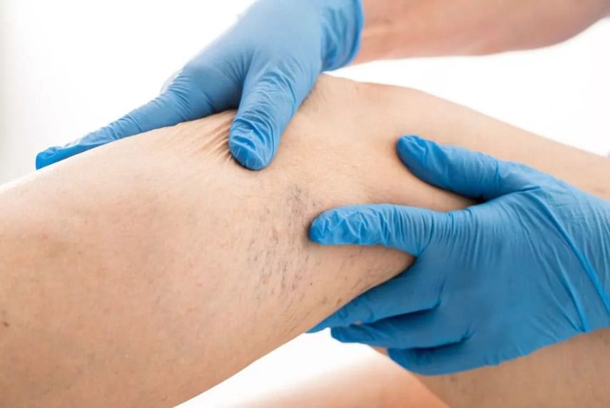 Традиционные методы лечения варикоза