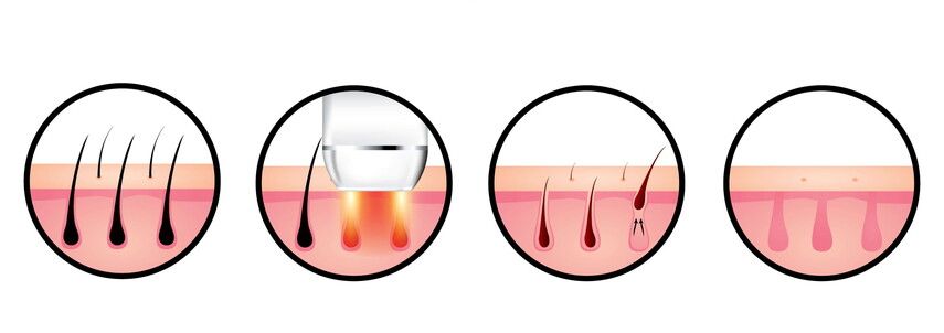 Принцип работы лазерной эпиляции