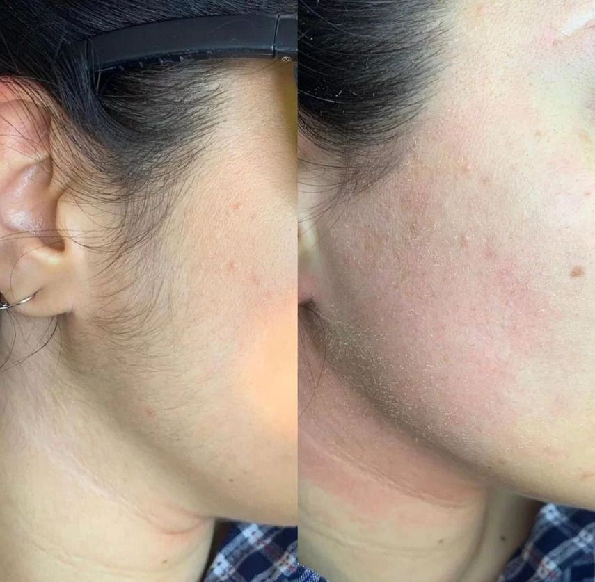 Кому подходит лазерная эпиляция