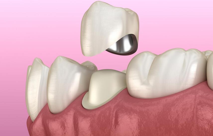 Виды зубных коронок
