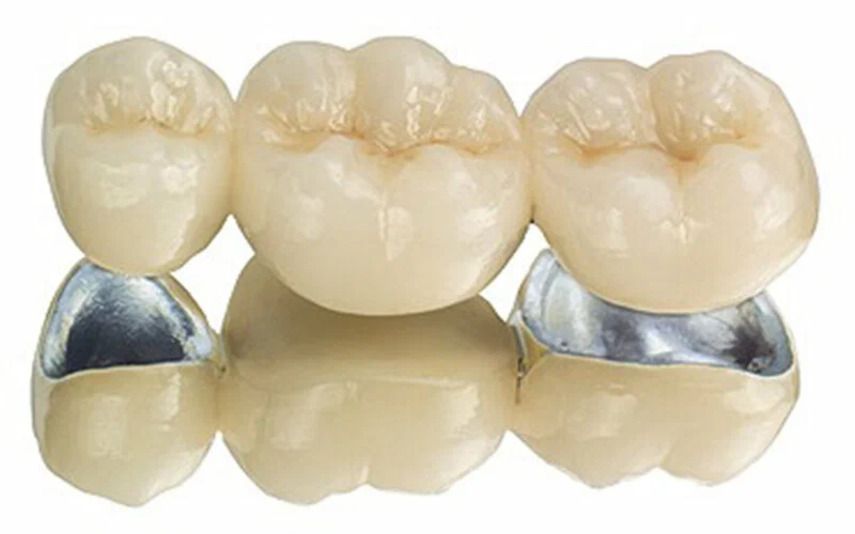 Металлокерамические коронки