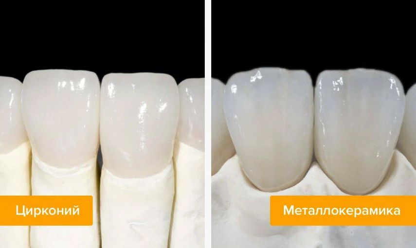 Коронки из диоксида циркония