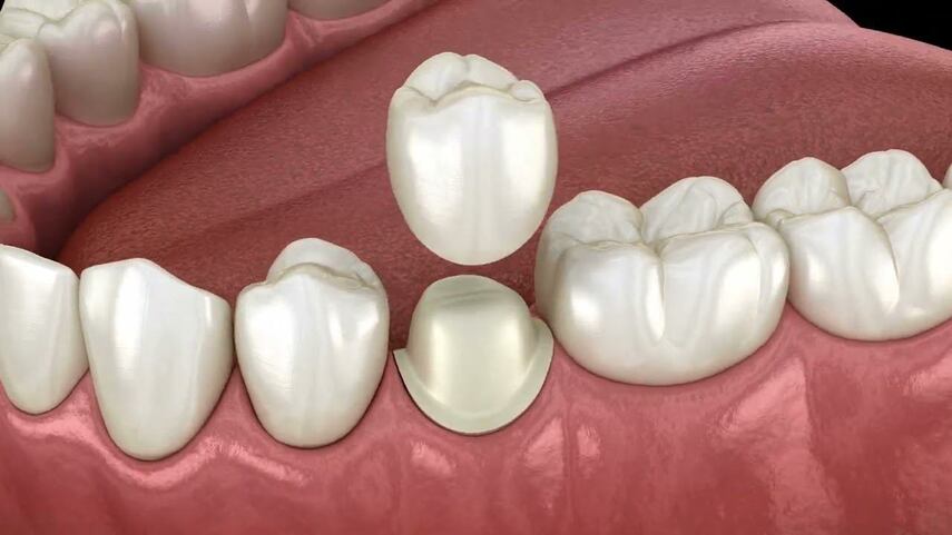 Процесс установки зубной коронки