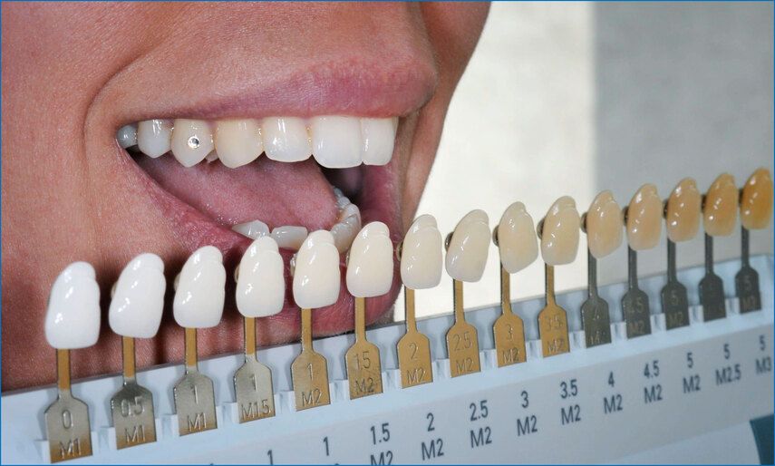 Выбор материала для коронки