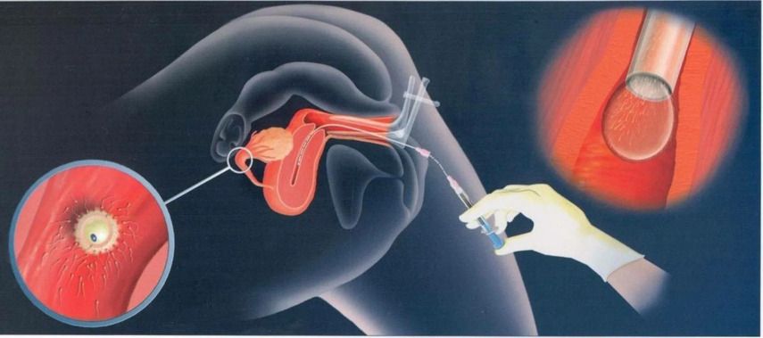 Что такое внутриматочная инсеминация (ВМИ)?