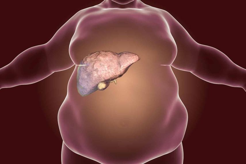 Причины возникновения жирового гепатоза