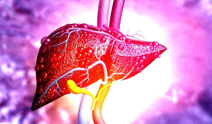  Жировой гепатоз печени: симптомы, лечение и профилактика от врача-гастроэнтеролога 